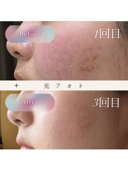 アヴァンス(AVANCE)/光フォト