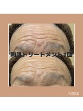 イルソーレ(IL Sole)/何歳になってもハーブピーリング