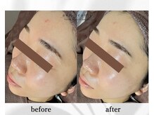 アン ビューティー(ann beauty)/施術1回【症例写真】20代女性