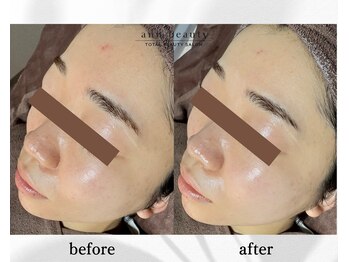 アン ビューティー(ann beauty)/施術1回【症例写真】20代女性