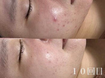 ホワイトアクア 天王寺本店(WHITE AQUA)/ハーブピーリング/毛穴/天王寺