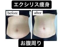 リベル(Liber)の雰囲気(温かい施術で痛み少なく引き締め・たるみケアできるエクシリス♪)