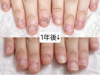 グラシナ なんば店/深爪/自爪育成/フィルイン