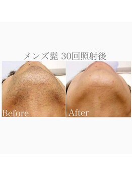 ハイリー(Hily)/メンズ脱毛 ヒゲ before after