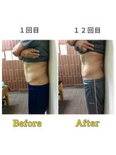 マリモ鍼灸接骨院/電磁パルス週1回12回目