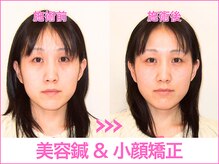 A1スポーツマッサージ治療院/【ビフォーアフター】美容鍼