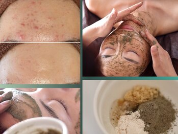 ユウビジン(YOU美人)/ニキビケア