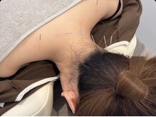 べっぷ餅ヶ浜鍼灸院/首肩の疲れケア