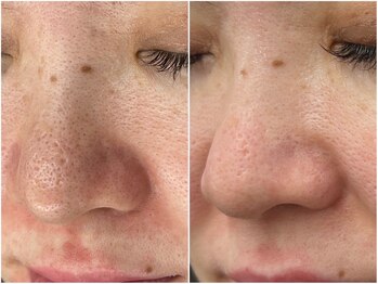 グランデ(Grande)/毛穴洗浄プラズマ組み合わせ◎