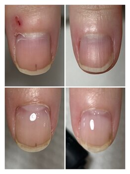 ハッチネイル(HACCI nail)/お客様　before after