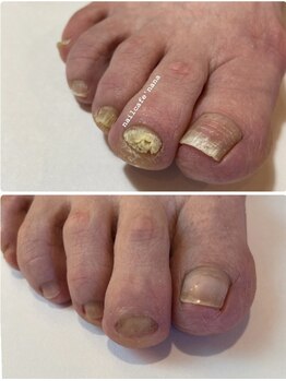 ネイルカフェ ナナ(nailcafe'nana)/足の爪にお悩みの方