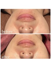 リコ(Relaxation Boutique LICO)/Wピーリング付　光フェイシャル