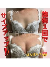 カリス(CHARIS)/アイリーン式１回の変化