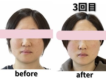 カルナー 武蔵小杉/フェイスライン、シュッと小顔