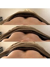 ミリム(milim)/【バストアップ/育乳】症例