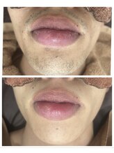 アカラ 読谷店(AKALA)/ヒゲ脱毛3ヶ月経過