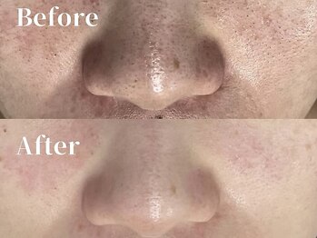 ひびき 京都烏丸御池店の写真/"毛穴洗浄×プラズマフェイシャル"で黒ずみ毛穴洗浄&毛穴引き締め◇憧れのうる艶美肌に♪くすみケアにも◎