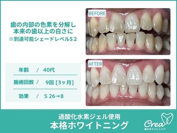 クレア(Crea)/【ホワイトニング症例写真】