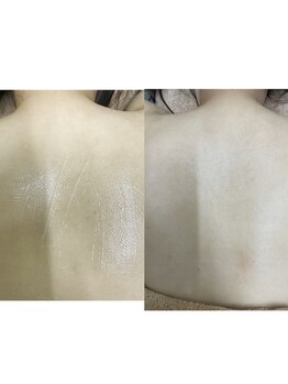 ナノハナ/鹿沼市の全身脱毛のナノハナ