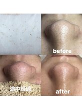 ビューティーネイル(Beauty Nail)/毛穴エクストラクション