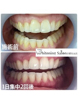 ホワイトニングサロン 京都烏丸店/ホワイトニング施術例　