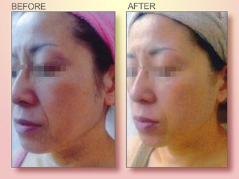 ジュリア オージェ 難波店/ビフォーアフター/イドラリフト