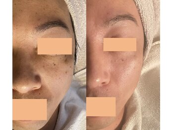 ティアラビューティ/シミケア諦めないで!