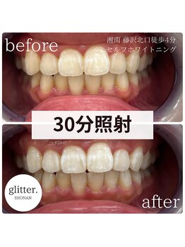 グリッター ショウナン(glitter. SHONAN)/老化での黄ばみも改善