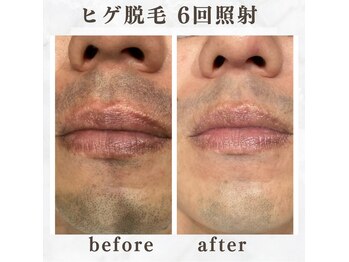 ボゴス 天白店(BOGOSS)/【ヒゲ脱毛】