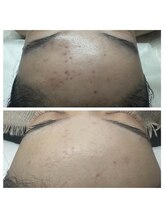 ソルテシュガーリング(SORTE sugaring)/光フェイシャル