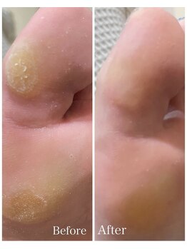 サロン ブルーミー 大井町店(Salon Bloomie)/足裏の角質除去、タコや魚の目も