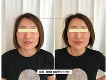 ナチュレアンドメディカ(Nature&Medica)/【たるみor小顔】ウルトラリフト