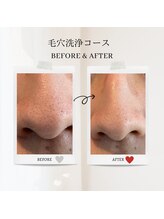 エクラ アン(eclat.un)/１０代男性：毛穴洗浄