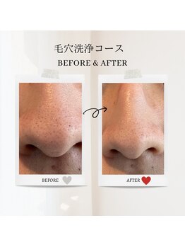 エクラ アン(eclat.un)/１０代男性：毛穴洗浄