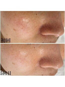 プラセル(Placer)/5回目で赤みがスッキリ☆