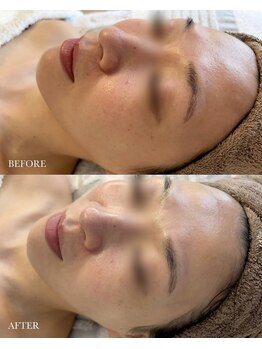 ソア/【美白】christinaピーリング1回