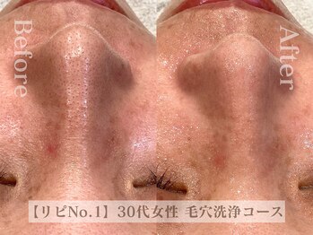 ディレイア ザ コスメ 有楽町マルイ店(direia the cosme)/毛穴洗浄/角栓/脂性肌［有楽町］