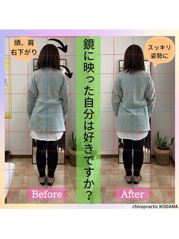 カイロプラクティック コダマ(KODAMA)/姿勢ビフォーアフター