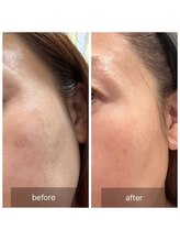 ゆう/大きなシミがなくなってる！