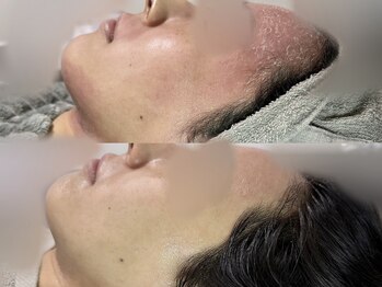 シルビー(CILBE)/保湿プラズマフェイシャルエステ