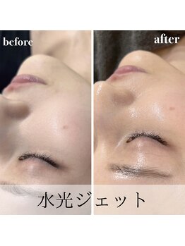 ナーズ(NAZ)/水光ジェット