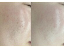 《毛穴・シミ・シワ・たるみ》大人の肌悩みもまるごとケア◎