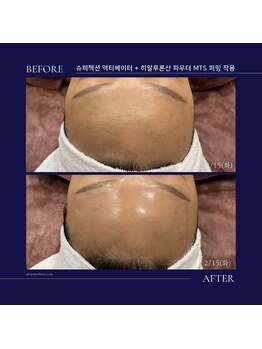 トータルクリア(TOTAL CLEAR)/韓国高級エステ「SUPERJECTION」