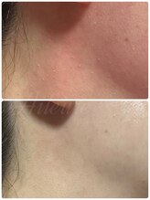 エルール トータルビューティ(Aileure total beauty)/老化でできる凸凹のぷつぷつ