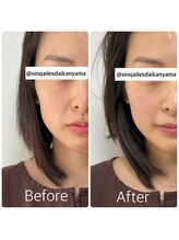 サンクエール 代官山鍼灸院(CINQ AILES)/美容鍼灸　食いしばり/小顔