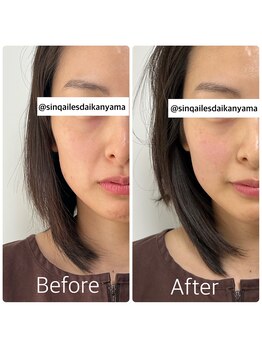 サンクエール 代官山鍼灸院(CINQ AILES)/美容鍼灸　食いしばり/小顔