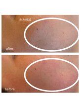 ヨリ(yori)/レストセルトリートメント　1回