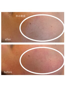 ヨリ(yori)/レストセルトリートメント　1回