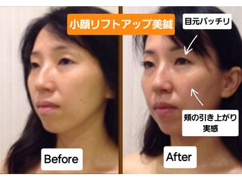 ラ コンシェル 武蔵小杉店/リフトアップ美鍼、お客様の結果