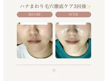 ネリネ(Nerine)/ハナまわり毛穴徹底ケア